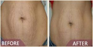 before after abdominoplasty