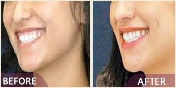Dimple surgery before after