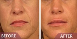 better Dermal Filler treatments before and after