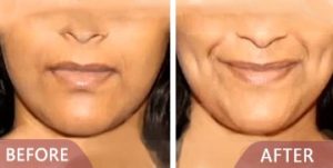 dimple creation before after