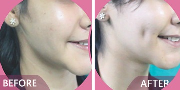 dimple creation before after