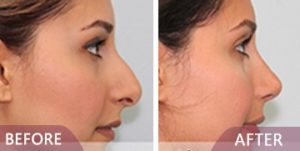 before after rhinoplasty results