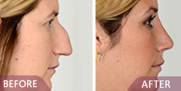 before after rhinoplasty results
